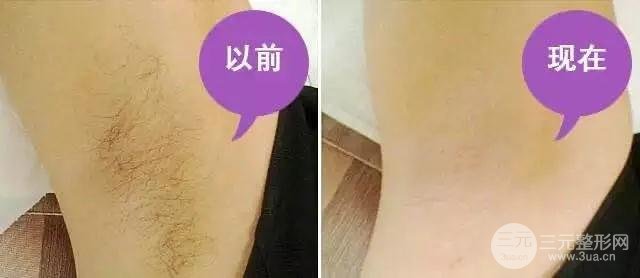 脱腋毛果对比