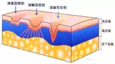 　莱芜艾美美容整形医院整形专家激光祛痘相关问答：