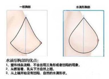 隆胸