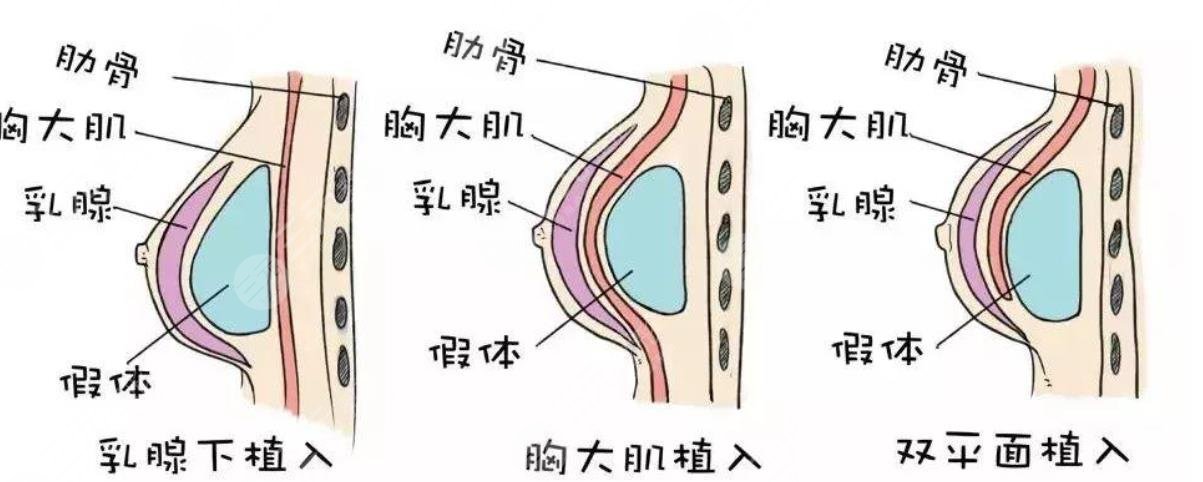 隆胸