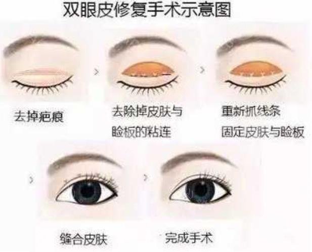 双眼皮失败修复的概念