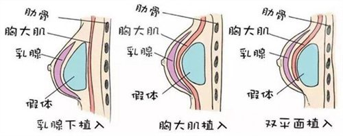 昆医附二院整形外科怎么样?隆胸案例分享