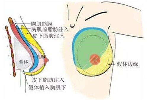 昆医附二院整形外科怎么样?隆胸案例分享