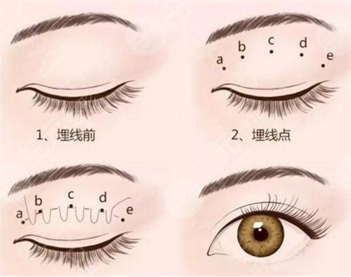 何栋良真实双眼皮案例