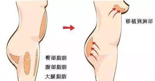 刘成胜脂肪填充丰胸案例