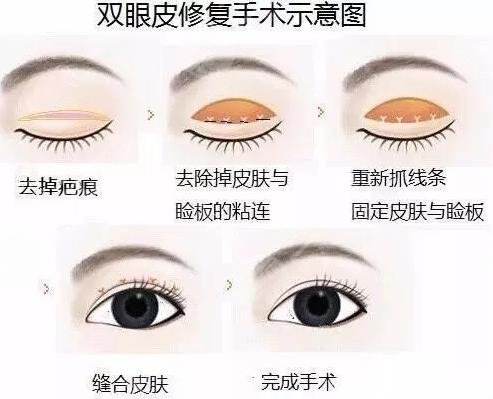 眼部整形失败修复原因