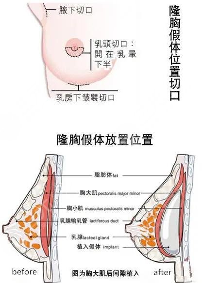 隆胸手术