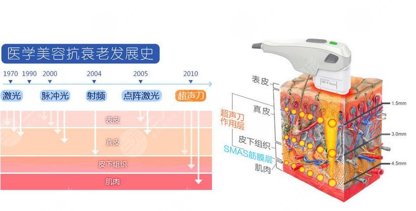 欧洲之星4d 与超声提拉的区别