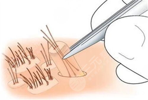 沈阳雍禾植发医院头发种植案例分享