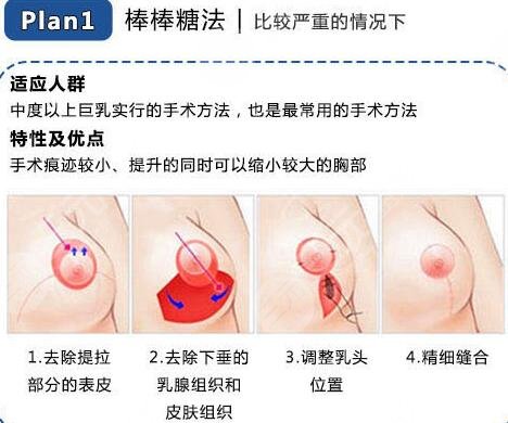 北京联合丽格第一医疗美容医院科普胸部整形