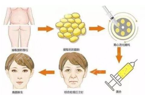 脂肪填充多久能恢复？填充脸部需要多少钱？附价格表+相关介绍