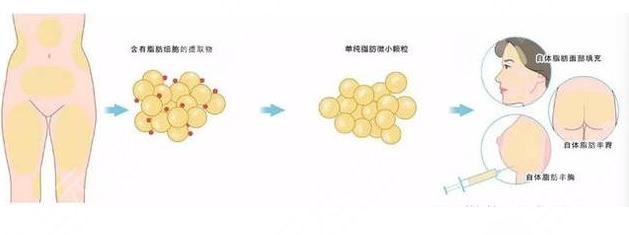 脂肪填充介绍