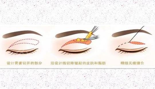 双眼皮全切过程