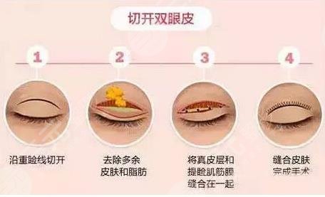 双眼皮全切过程