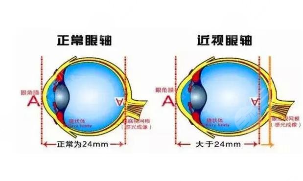 凸眼问题如何矫正?