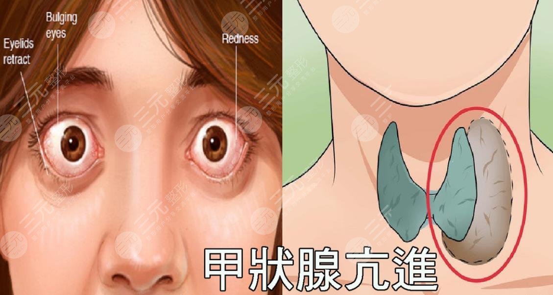凸眼问题如何矫正?