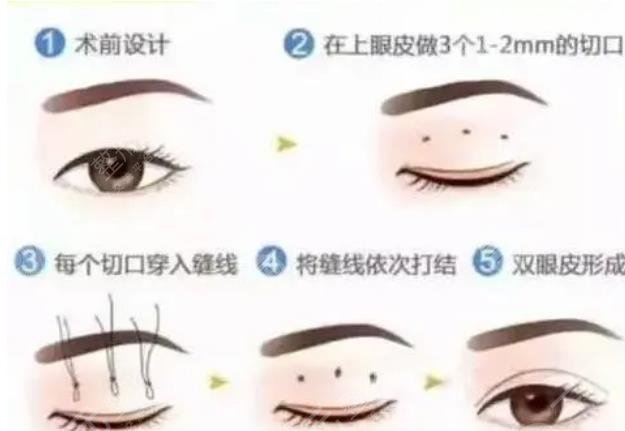 大连沙医生双眼皮修复知识
