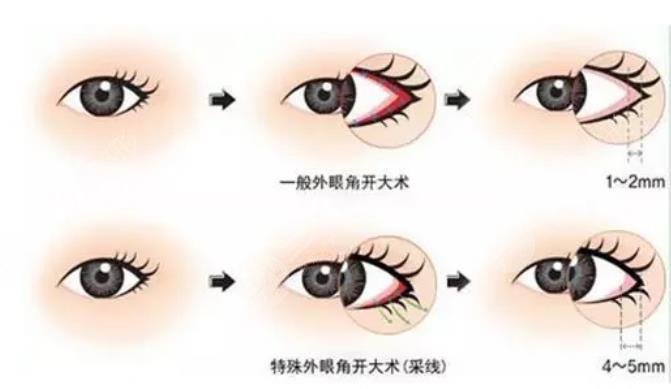 开眼角手术适合人群