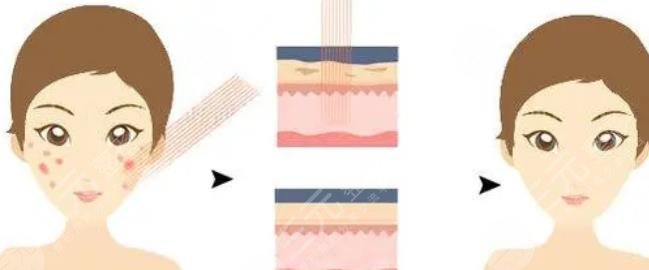 点阵激光美容