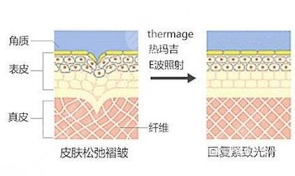 热玛吉有什么果和副作用