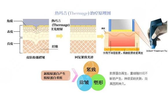 热玛吉改善果怎么样