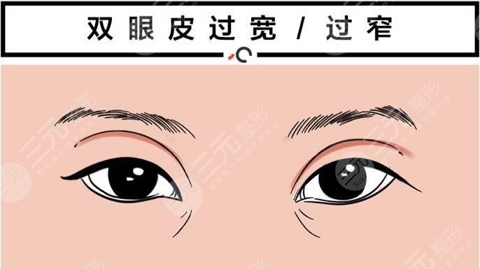 双眼皮失败的八种图片