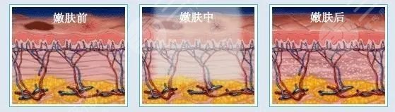 激光嫩肤有后遗症吗,一般多少钱
