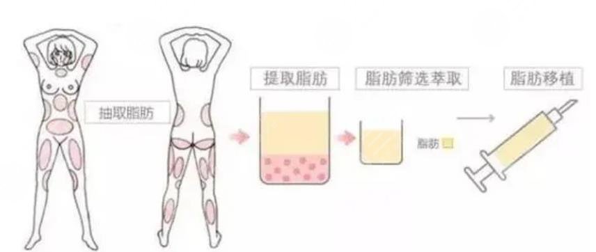 自体脂肪隆胸