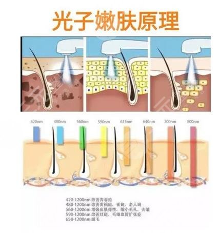 光子嫩肤