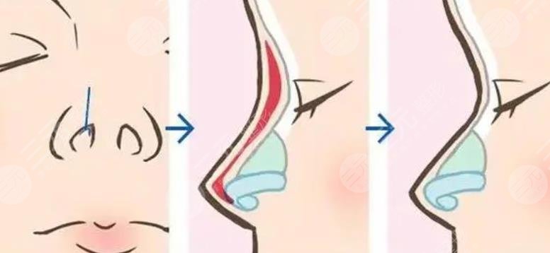 硅胶假体隆鼻几天消肿