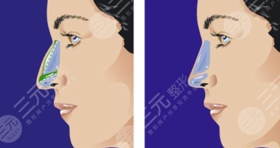 硅胶假体+半肋隆鼻好不好