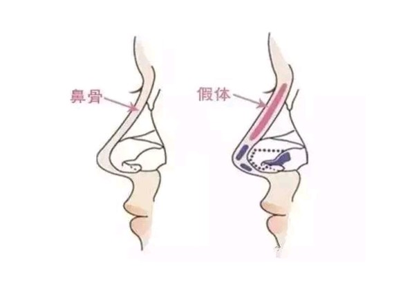 　301医院薛志强医生科普鼻部整形
