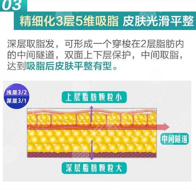 吸脂抽脂手术的好处