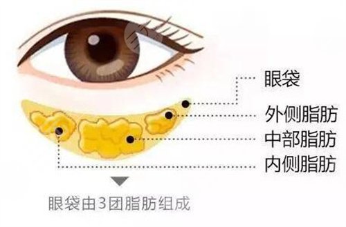 广州华美医疗美容医院去眼袋案例