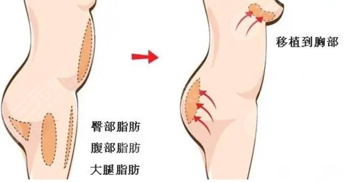 自体脂肪隆胸多少钱