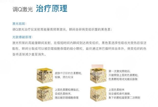 激光祛黄褐斑原理