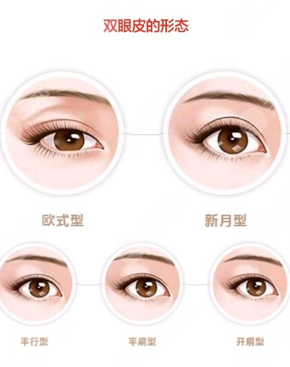 双眼皮修复