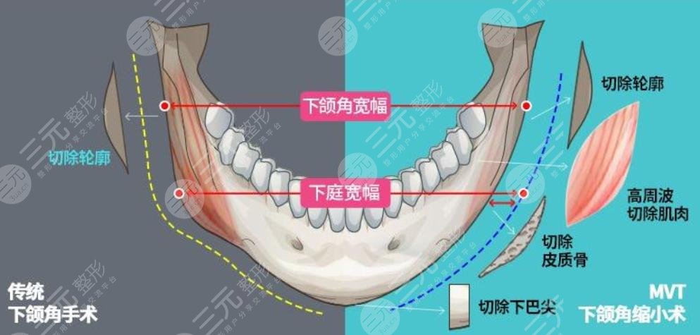 下颌角截骨