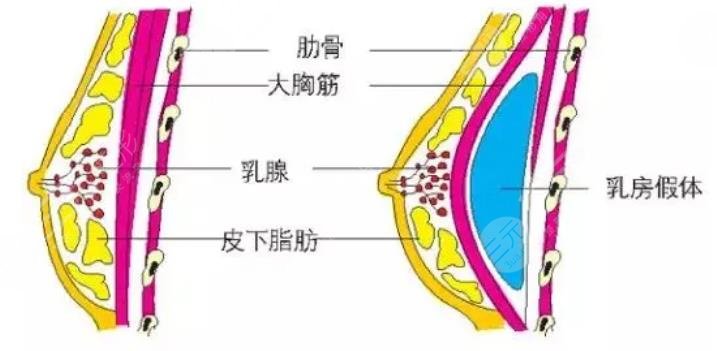 隆胸手术原理