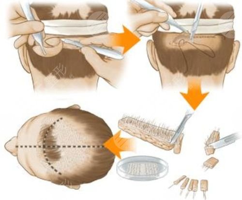 种植头发适用于哪些人群