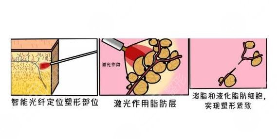 超脂塑溶脂有哪些优势