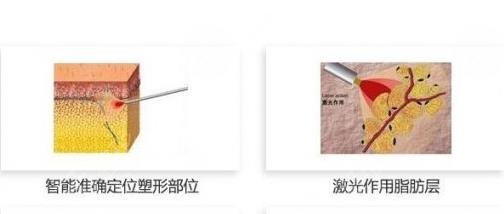 超脂塑溶脂手术的适应症