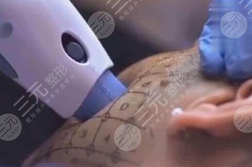 热玛吉做完出现哪些正常的反应