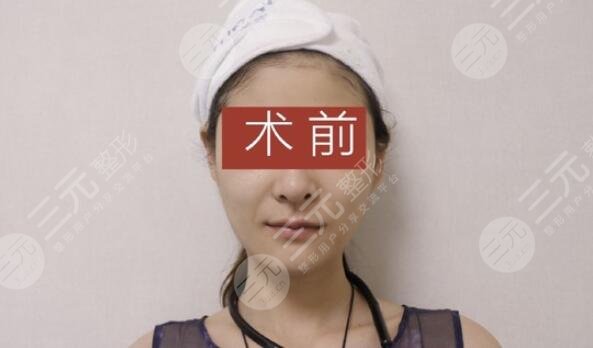热玛吉前
