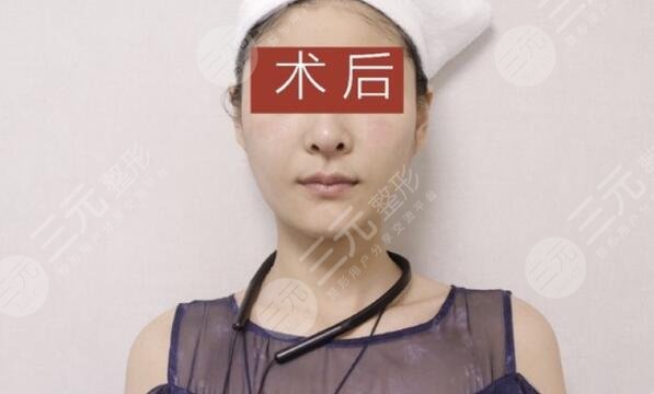 热玛吉后