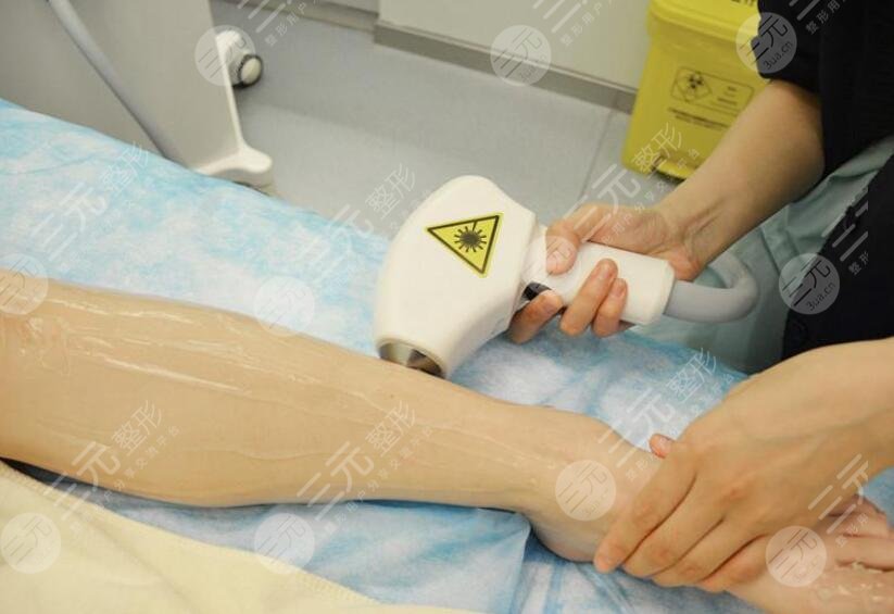 激光脱毛