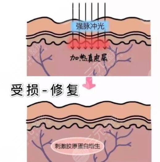 点阵激光