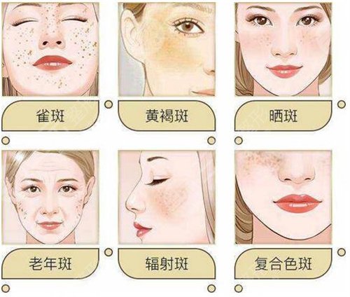 上海九院激光去雀斑案例