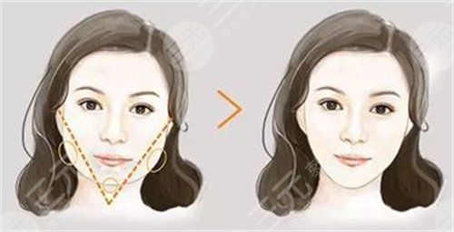 成都八大处整形医院面部吸脂案例