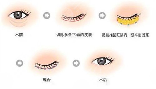 聚能美雕去眼袋成功案例后34天